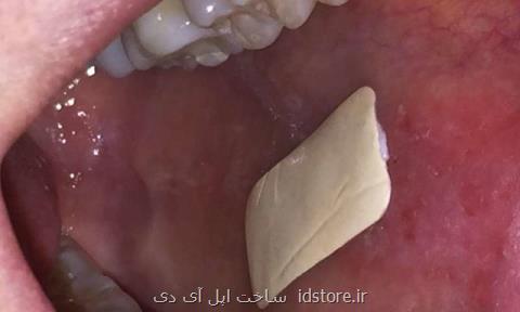 ابداع نوعی پچ برای درمان زخم های داخل دهان
