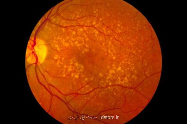 نقص عملکرد پروتئین تنظیم سیستم ایمنی علت شایع نابینایی در بزرگسالان