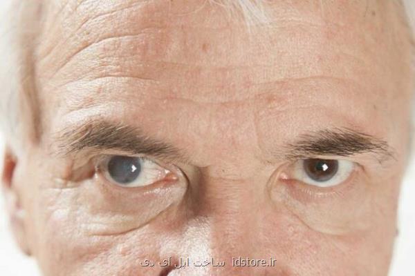 شناسایی جهش پروتئینی مهم که سبب آب مروارید و نابینایی می شود
