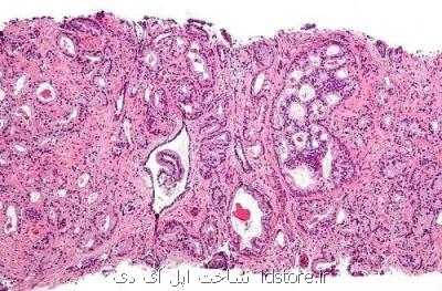 تشخیص سرطان پروستات تنها با یك آزمایش ادرار